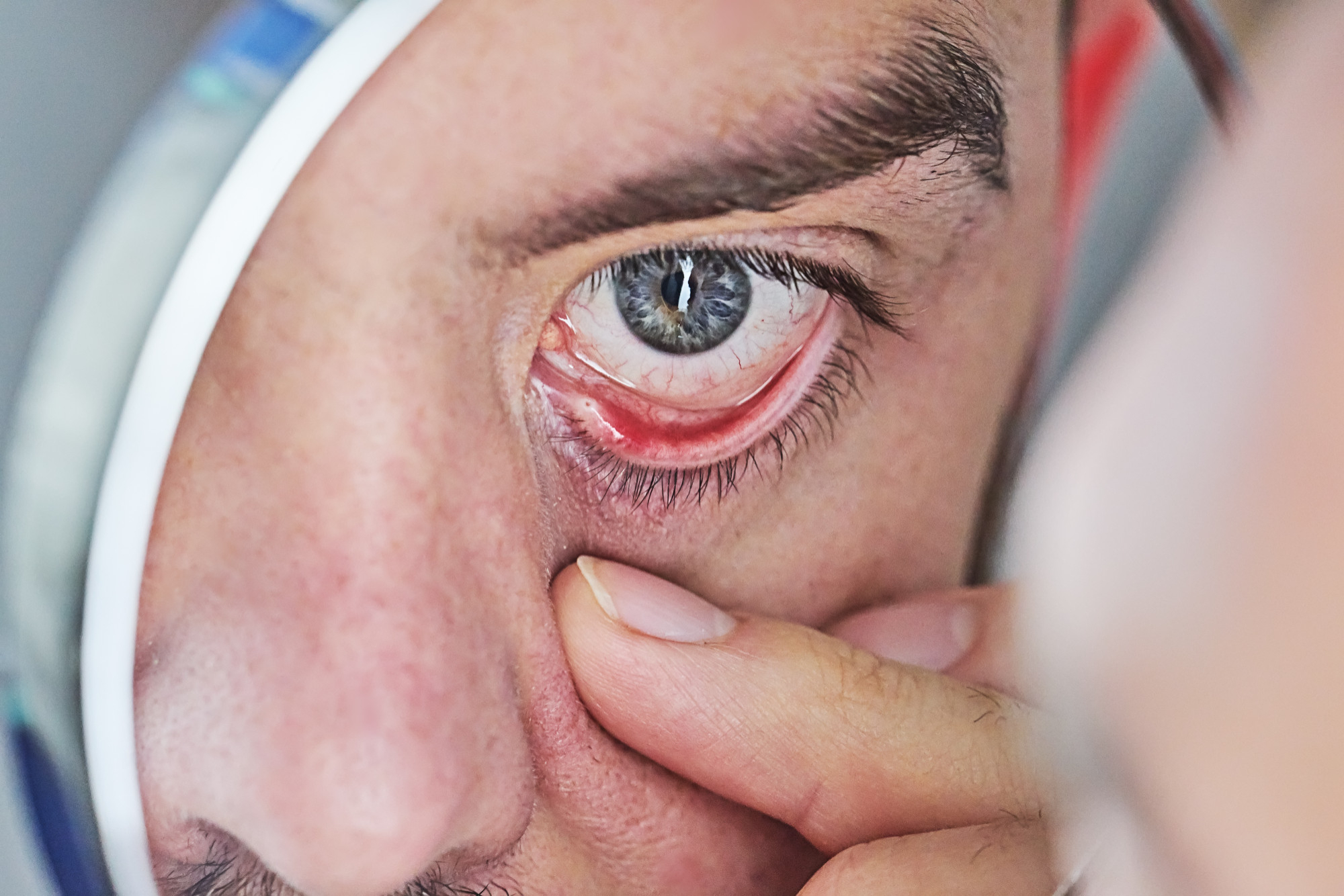 Cataract
